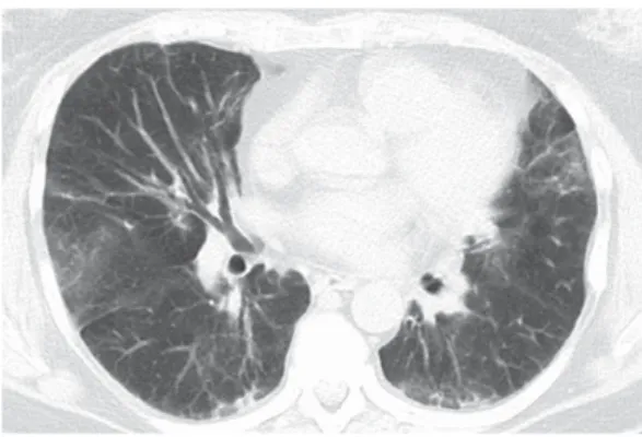 Figure 2 - Lung biopsy from a patient with  antisynthetase syndrome and interstitial lung disease  showing cellular interstitial infiltrate and organizing  pneumonia (arrow).