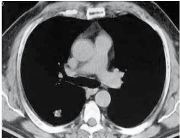Figure 1 - CT scan of the chest showing a nodule  of 2 cm in diameter, with ill-defined borders,  without calcifications, and without any evidence of  adenopathy or pleural involvement.