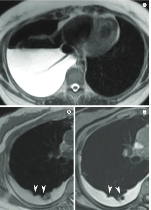 Figure 2 - Magnetic resonance imaging (MRI). In A, axial, T2-weighted MRI sequence of the lower third of  the hemithorax showing right hydropneumothorax