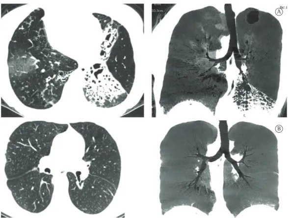 Figura 1 - Em A, TCs de tórax no pré-operatório evidenciando as áreas de bronquiectasias