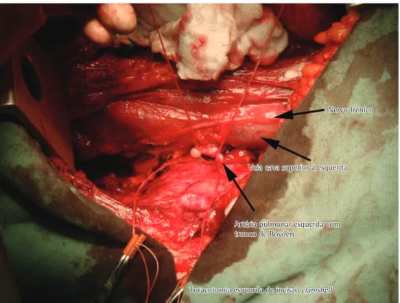 Figura 2 - Hemitórax esquerdo evidenciando a localização da veia cava à esquerda e ligadura dos vasos  para a pneumonectomia.