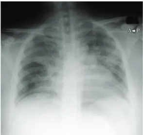 Figure 1 - Chest X-ray showing bilateral shadows  predominantly in the hilar region.