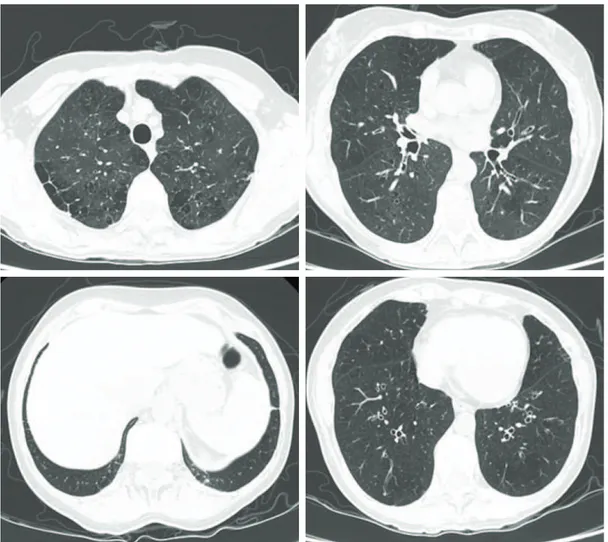 Figure 1 - HRCT scan showing centrilobular and paraseptal emphysema, cylindrical bronchiectasis, and two  micronodules (one in the left lower lobe and the other in the right lower lobe).