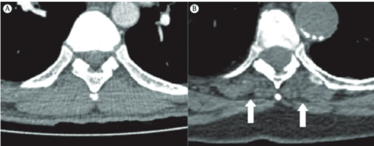 Figure 1 - CT Images. In A, a 25-year-old individual, and in B, an 86-year-old individual