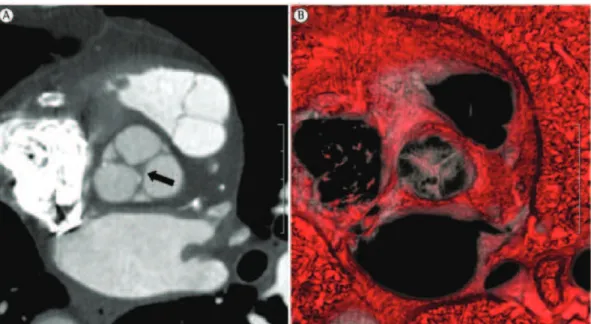 Figure 2 - Cardiac CT scan. In A, reconstruction of an aortic valve during systole, showing thickening of  the valve leaflets in an 88-year-old patient with no history of cardiovascular disease