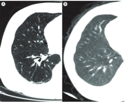 Figure 4 - Axial CT scan in a 78-year-old individual (in A) and in a six-month-old child (in B)