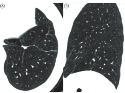 Figure 5 - Asymptomatic 87-year-old female patient. In A, axial CT scan of the left lower lobe showing  laminar atelectasis at the lung bases