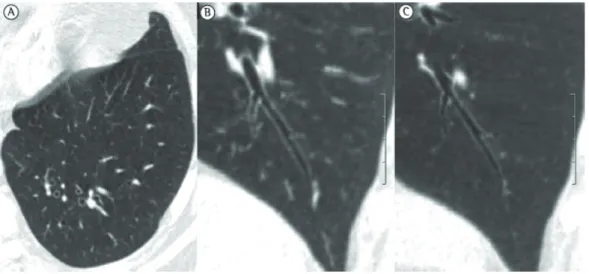 Figure 8 - Asymptomatic 79-year-old patient. In A, axial CT scan of the left lower lobe, showing areas of  bronchial thickening and ectasia