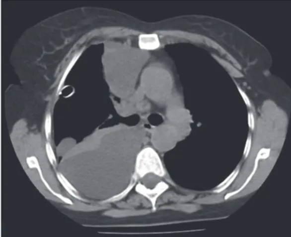 Figure 1 - Posteroanterior chest X-ray showing pleural  effusion in the right hemithorax.