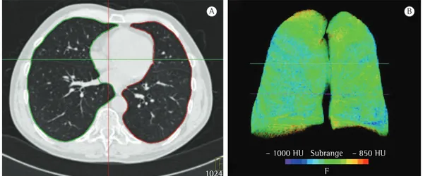 Figure 1 - CT scans of an 83-year-old male patient with an emphysema index of 6.4%. In A, an axial CT  image showing the automatic recognition of the lung margins by the software