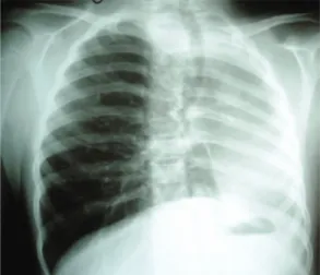 Figure 1 - Posteroanterior chest X-ray revealing  compensatory hyperinflation of the right lung due  to the absence of the left lung and leftward deviation  of the mediastinal structures