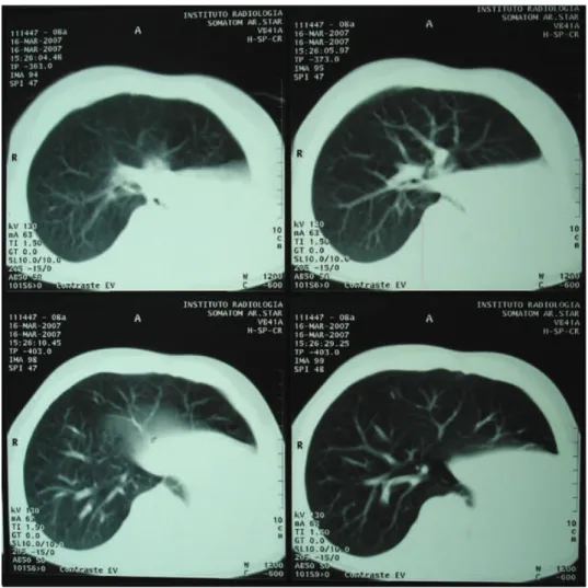 Figure 2 - Intravenous contrast-enhanced CT scan of the chest revealing compensatory hypertrophy of the  right lung and normal pulmonary circulation with leftward deviation of the mediastinal structures due to  left lung agenesis.