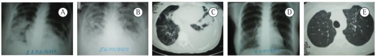 Figura 1 - Em A, radiografia de tórax no 2º dia de internação, revelando opacidade alveolar nas bases