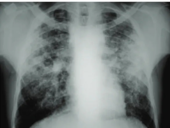 Figure 3 - Chest X-ray of a patient with tuberculous  pneumonia, revealing consolidation in the right lower  lobe.