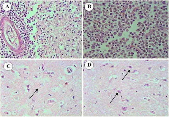 Figura  3.  Encéfalo  de  um  bovino  com  meningoencefalite  pelo  BHV-5.  A:  Manguito  perivascular  linfohistiocitário,  intenso (à esquerda) e malacia moderada com substituição do neurópilo por células “Gitter” na meningoencefalite por  BHV-5