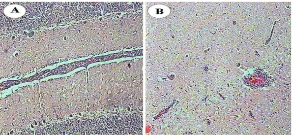 Figura  7.  Exame  histopatológico  do  encéfalo  de  um  bovino  que  morreu  apresentando  sinais  nervosos  com  um  diagnóstico positivo para o BHV-4