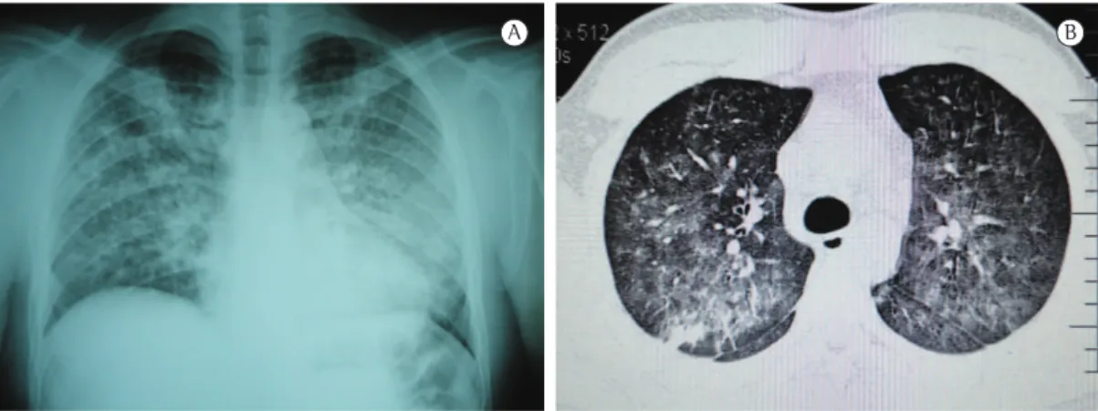 Figure 2 - Normal chest X-ray after six months on  a gluten-free diet.