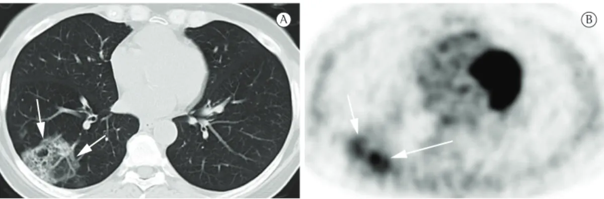 Figure 8 - Images of a 49-year-old female patient diagnosed with adenocarcinoma with a 50% bronchioloalveolar  component