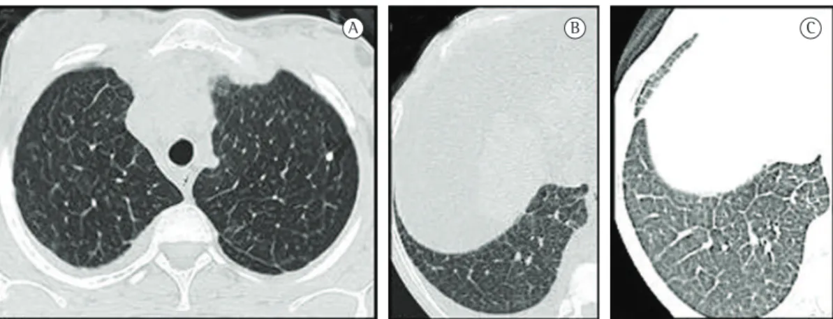 Figure 1 - HRCT scans. In a and b, interlobular septal thickening in the bases and apices, together with right  pleural effusion