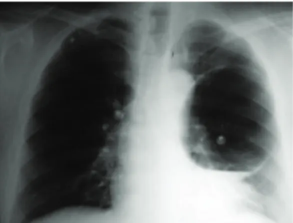 Figure 1 - Hypertransparent area in the middle third  of the left lung compressing the lung parenchyma.