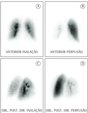 Figure 1 - Lung scintigrams showing right lung  hypoperfusion with ipsilateral preservation of ventilation