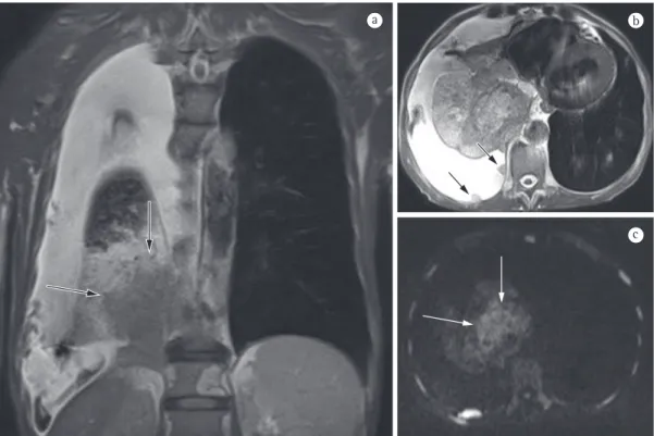 Figure 2 - In a, coronal T2-weighted magnetic resonance image showing a tumor with low signal intensity  in the right lung and atelectasis with high signal intensity in the right lower lobe of the lung
