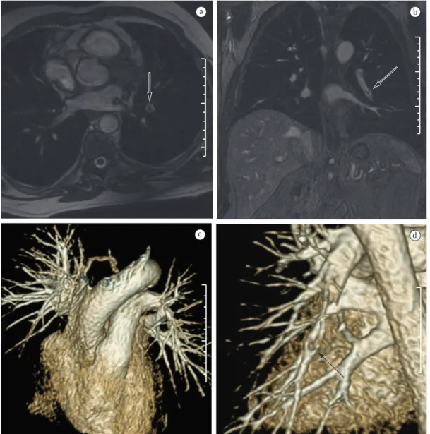 Figure 5 - In a, axial T2-weighted magnetic resonance image without contrast media. Note the thromboembolic  material in left lower lobe pulmonary artery (arrow)