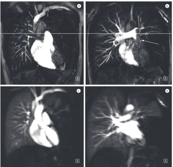 Figure 6 - In a and b, high spatial resolution coronal magnetic resonance angiography with contrast media,  showing an avascular area in the left lung (a) and a filling defect in the left pulmonary artery (b, arrow)