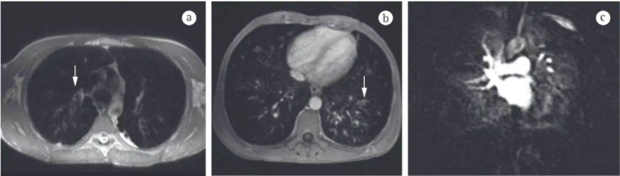 Figure 7 - In a and b, axial T1-weighted gradient-echo magnetic resonance imaging sequence (volumetric  interpolated breath-hold examination), with an isotropic resolution of 1 mm, showing bronchiectasis with  mucoid impaction (arrows)