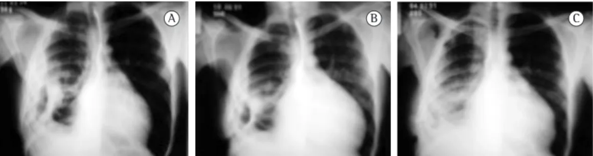 Figure 1 - Chest X-rays. In A, open pleural cavity (time of pleural secretion collection when there was the  finding of a fungal ball caused by  Aspergillus fumigatus —aspergilloma—in the pleural cavity)