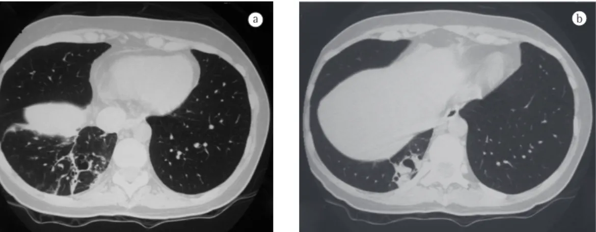 Figure 2 - In A, CT scan of the chest revealing cystic areas permeated by fibrotic tissue in the right lower lobe