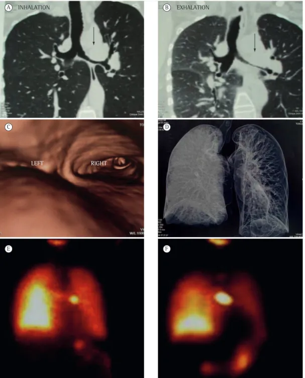 Figure 1 - Coronal reconstruction of multidetector chest CT scans acquired during inhalation (A) and exhalation  (B), endobronchial reconstruction of a multidetector chest CT scan (C), and volumetric reconstruction of a  multidetector chest CT scan acquire