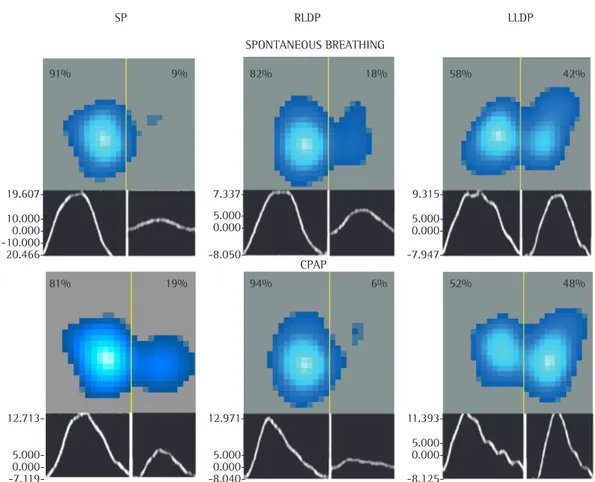 Figure 2 - Functional map of the distribution of regional lung ventilation as assessed by electrical impedance  tomography in the supine position (SP), in the right lateral decubitus position (RLDP), and in the left lateral  decubitus position (LLDP)
