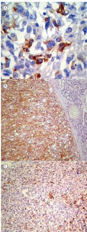 Figura 1 - Fotomicrografias de estudos patológicos  e imuno-histoquímicos. Em A, células tumorais  apresentando positividade citoplasmática para  pancitoqueratina (imunocoloração para AE1/AE3; 