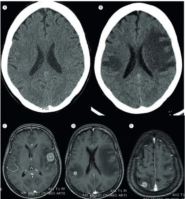 Figura 2 - Neuroimagens. Em A, TC de crânio, aparentemente normal, realizada quando a massa pulmonar foi  descoberta, quatro meses antes do aparecimento de sintomas neurológicos