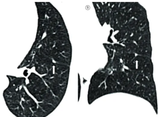 Figura 1 - Em A, imagem axial de TC de tórax (janela pulmonar) de um homem de 53 anos de idade