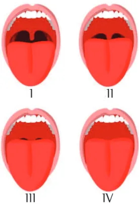 Figure 1 - Modified Mallampati score. (17) 