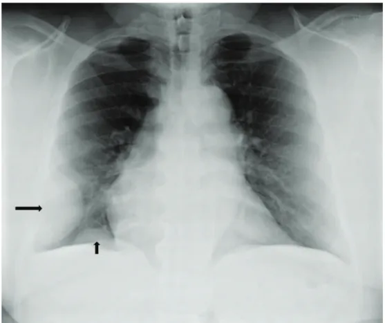 Figura 1 - Radiografia de tórax em incidência posteroanterior. Podem ser vistas duas massas, com margens  lisas; uma maior, na parte lateral do tórax inferior direito (seta maior), e uma menor, logo acima do diafragma  direito, perto do ângulo cardiofrênic