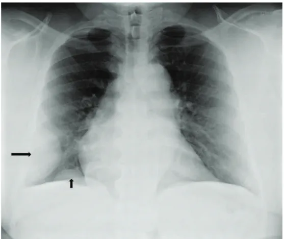 Figure 2 - CT scans. In A, axial image, mediastinal window setting. The regular margin and homogeneous  fat content of the mass in the lateral thoracic wall can be easily seen