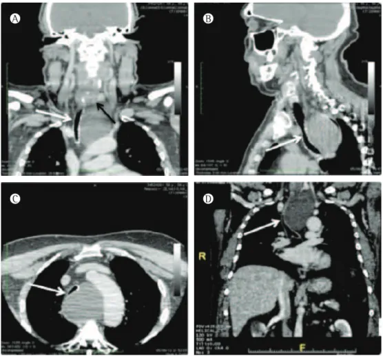 Figure 1 - Chest CT scans. In A, coronal reconstruction showing compression of the trachea (light arrow) by  the lesion and contact of the lesion with the lower pole of the left lobe of the thyroid gland (dark arrow)