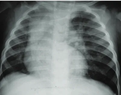 Figure 1 - Chest X-ray showing hyperinflation of the left upper lobe, with compression of the lower lobe  and mediastinal shift to the right leading to compression of the entire right lung