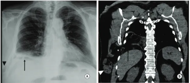 Figure 1 - In A, posteroanterior chest radiograph. The arrow demonstrates opacification at the base of the  right hemithorax, interspersed with some gas images