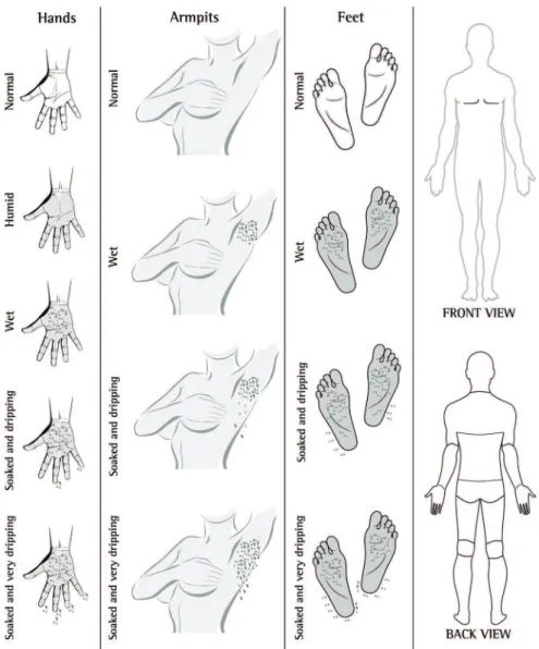 Figure 1 - Visual scale for the quantification of hyperhidrosis.