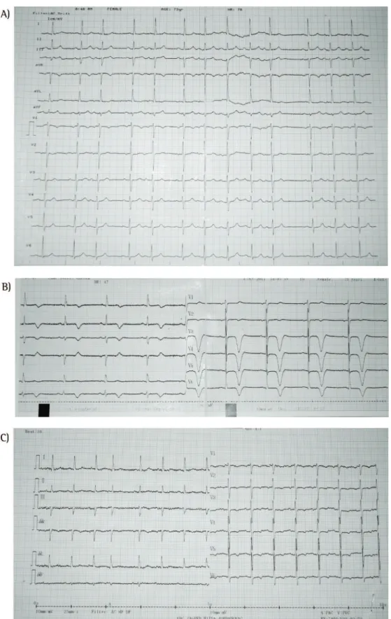 Figura 1 - Eletrocardiogramas. Em A, ritmo sinusal normal com um batimento ectópico supraventricular e  alterações inespecíficas do segmento ST-T nas derivações precordiais