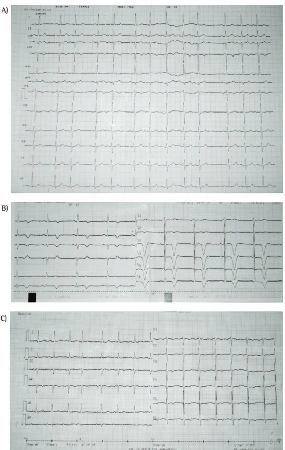 Figure 1 - Electrocardiograms. In A, normal sinus rhythm with one supraventricular ectopic beat and nonspecific  ST-T segment abnormalities in precordial leads