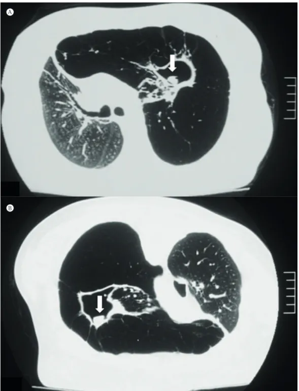 Figure 1 - Axial HRCT scans. In A, cavitary lung lesion in the left upper lobe filled with an opacity resembling  a fungus ball (arrow)