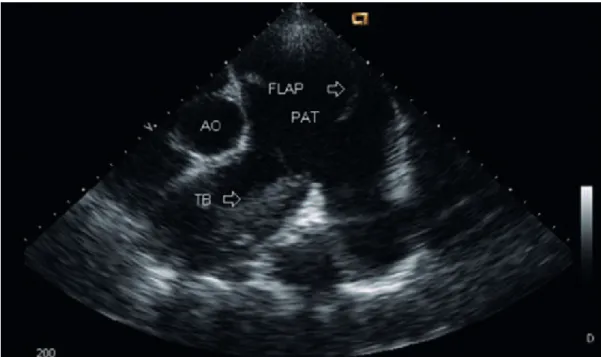Figure 1 - Transthoracic echocardiogram depicting a thrombus (TB) in the right pulmonary artery and a  flap at that level, which is consistent with pulmonary artery dissection