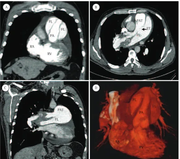 Figure 2 - CT pulmonary angiography scans depicting a flap in the area of dissection in the pulmonary  artery trunk (PAT; in A); in situ thrombus (TB) and the entry tear (ET, arrow) into the false lumen (FL; in B); 