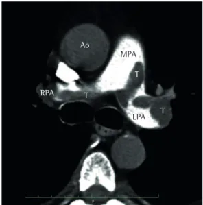 Figure 1 - CT scan of the chest showing various  intraluminal filling defects—thrombi (T)—involving the  main pulmonary artery (MPA), the left pulmonary artery  (LPA), and the right branches of the right pulmonary  artery (RPA)