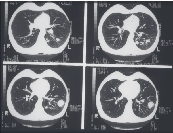 Figure 1 - Pulmonary histoplasmosis in a 29-year-old female patient with a history of melanoma and  treatment with antineoplastic agents (patient 5)